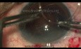 Catarata traumática con lente subluxada
