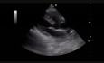Defecto del tabique ventricular (VSD) subaórtico (1)