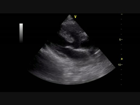 Defecto del tabique ventricular (VSD) subaórtico (1)