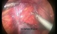 Cirugía de varicocele