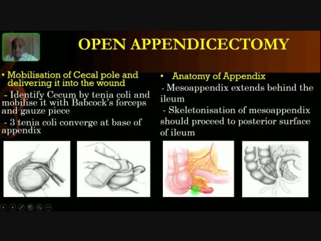 Apendicectomía abierta