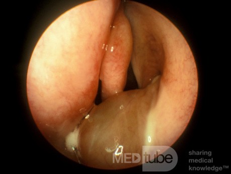 Pólipo antrocoanal