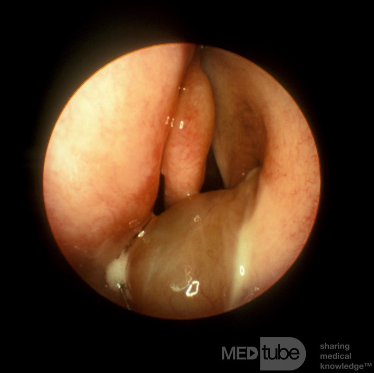 Pólipo antrocoanal