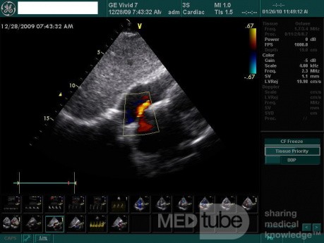 Foramen oval permeable (FOP)