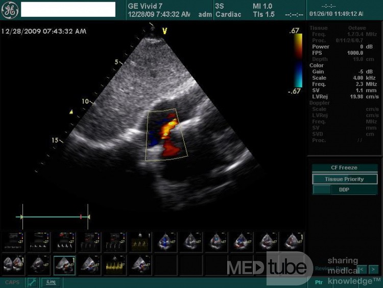 Foramen oval permeable (FOP)
