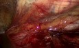 Hernia inguinal incarcerada (TAPP)