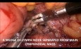 Biopsia laparoscópica del ganglio linfático paraaórtico
