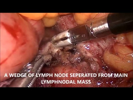 Biopsia laparoscópica del ganglio linfático paraaórtico
