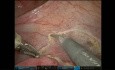Cirugia asistida por robot para el tratamiento de la endometriosis