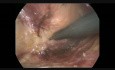 Resección anterior ultrabaja laparoscópica + EMT