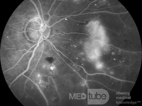 Retinopatía diabética proliferativa en la angiografía fluoresceínica