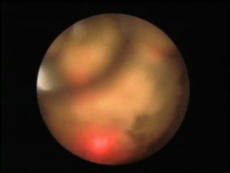 Ureteroscopia