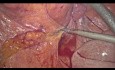 Diverticulitis complicada con fístula colovesical