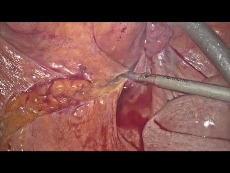 Diverticulitis complicada con fístula colovesical