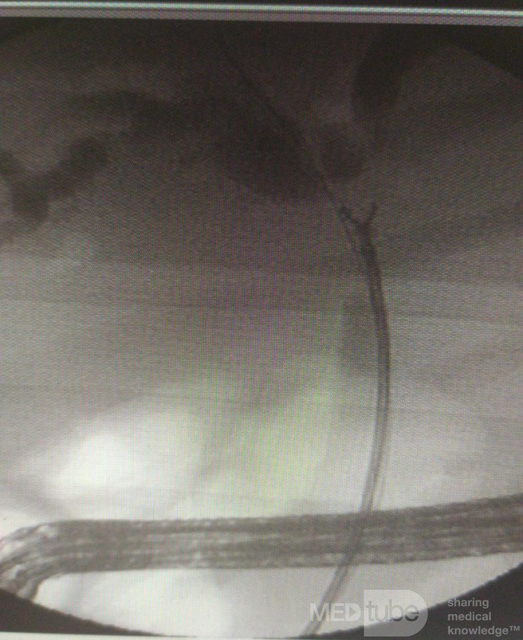 Biopsia directa en frío con fórceps de colangiocarcinoma hiliar bajo fluoroscopia 