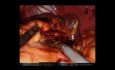 Gastrectomía, esplenectomía y pancreatectomía distal robótica para masa gástrica