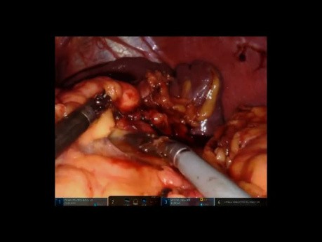 Gastrectomía, esplenectomía y pancreatectomía distal robótica para masa gástrica