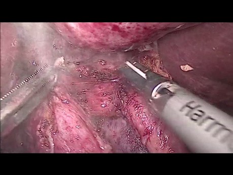Colecistectomía radical laparoscópica y linfadenectomía debido al cáncer de vesícula biliar