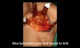 Biopsia de ganglio centinela en cáncer de mama
