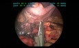 Resección laparoscópica de la arteria esplénica para el tratamiento de cuatro aneurismas de la arteria esplénica 