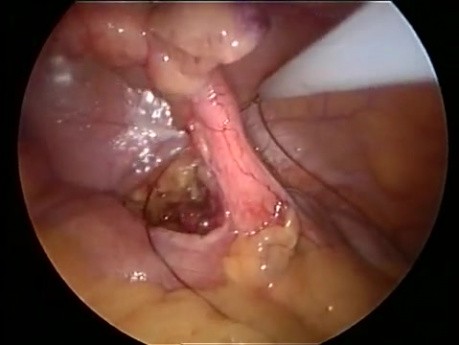Apendicectomía laparoscópica usando el método SILS