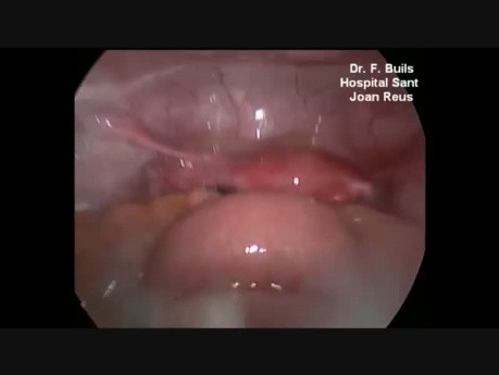 Tratamiento laparoscópico de la perforación yeyunal en traumatismos abdominales cerrados