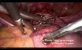 Reparación laparoscópica del istmocele