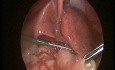 Esterosis pilórica hipertrófica en lactantes