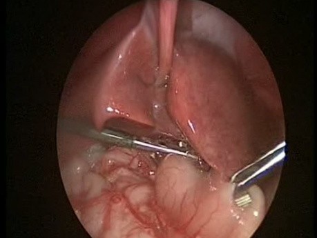 Esterosis pilórica hipertrófica en lactantes