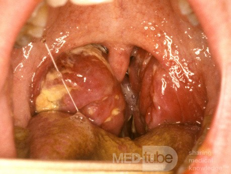 Amigdalitis unilateral con compromiso de las vías respiratorias