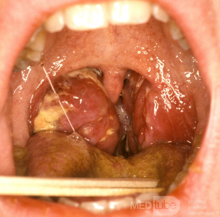 Amigdalitis unilateral con compromiso de las vías respiratorias