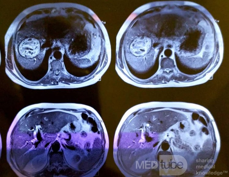 Quiste hidatídico hepático, CBC y colangitis, extracción de quiste hijo con CPRE