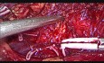 Linfadenectomía retroperitoneal laparoscópica