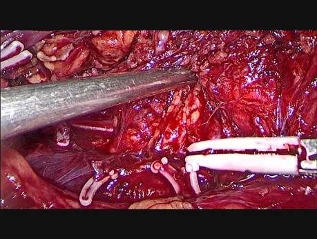 Linfadenectomía retroperitoneal laparoscópica