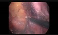 Anastomosis ileorrectal con reservorio en "J" de colectomía total laparoscópica