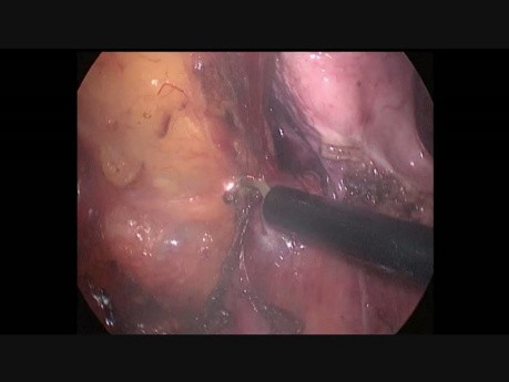 Anastomosis ileorrectal con reservorio en "J" de colectomía total laparoscópica