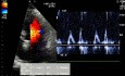 Un paciente con hipertensión. El ECG, el ecocardiograma y la función diastólica del ventrículo izquierdo.