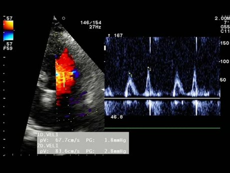 Un paciente con hipertensión. El ECG, el ecocardiograma y la función diastólica del ventrículo izquierdo.