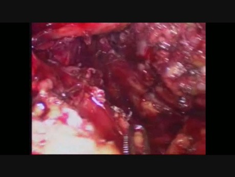 Esofagectomía transhiatal laparoscópica