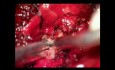 Tumor paravertebral de la columna torácica