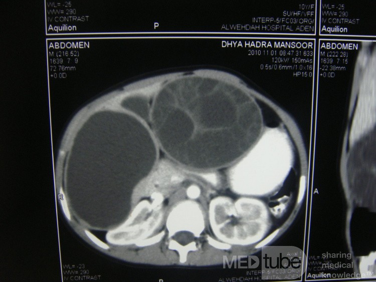 Quiste hidatídico hepático derecho e izquierdo - TC abdominal