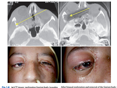 Traumatismo craneofacial