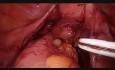 Resección rectal anterior baja laparoscópica con reparación intraoperatoria de fuga