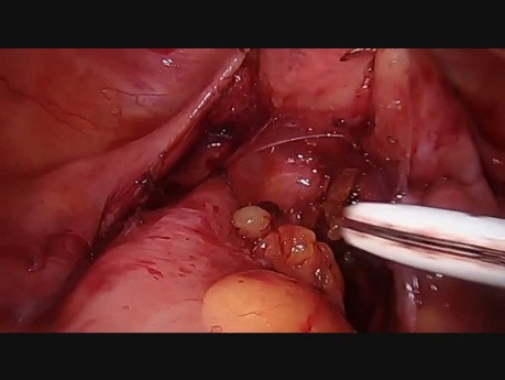 Resección rectal anterior baja laparoscópica con reparación intraoperatoria de fuga