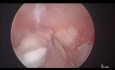 Extirpación de un pólipo endometrial - polipectomía
