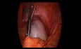 Ovario Tumorectomia Asistida Por Laparoscopia