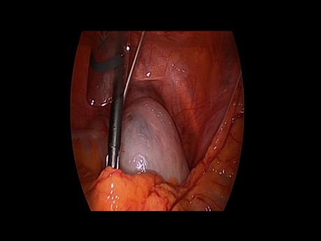 Ovario Tumorectomia Asistida Por Laparoscopia