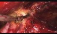 Reparación laparoscópica de hernia umbilical con TEP