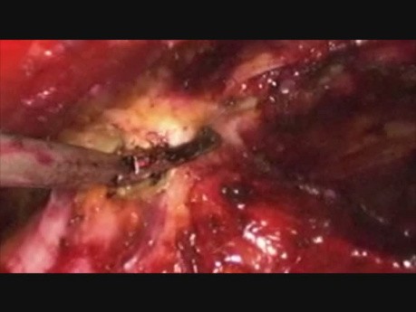 Reparación laparoscópica de hernia umbilical con TEP