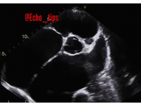 10. Caso de ecocardiografía - ¿Qué se ve?